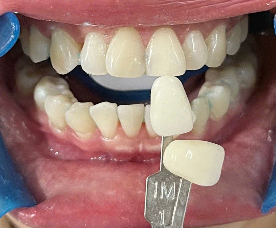 Tẩy trắng răng Laser Cái Nước