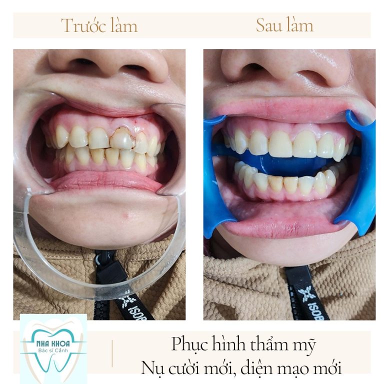 rang su bs canh cai nuoc 2