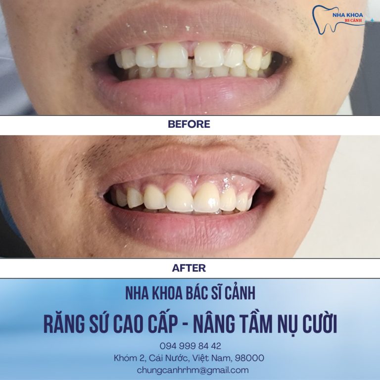 rang su bs canh cai nuoc