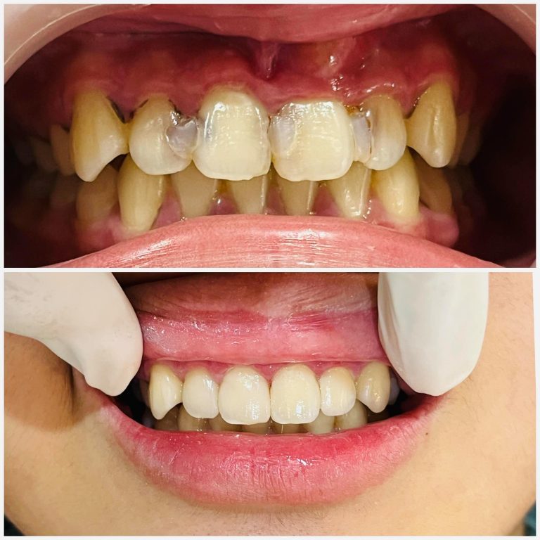 tram rang bs canh cainuoc