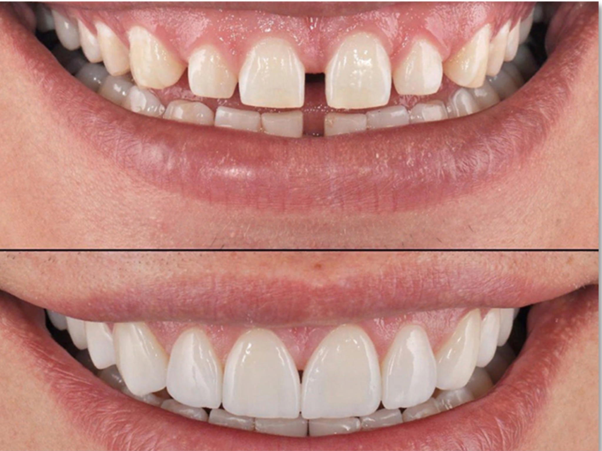 Mặt dán sứ Veneer