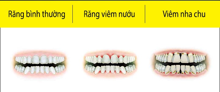 dieu tri viem nuou hoi mieng cai nuoc